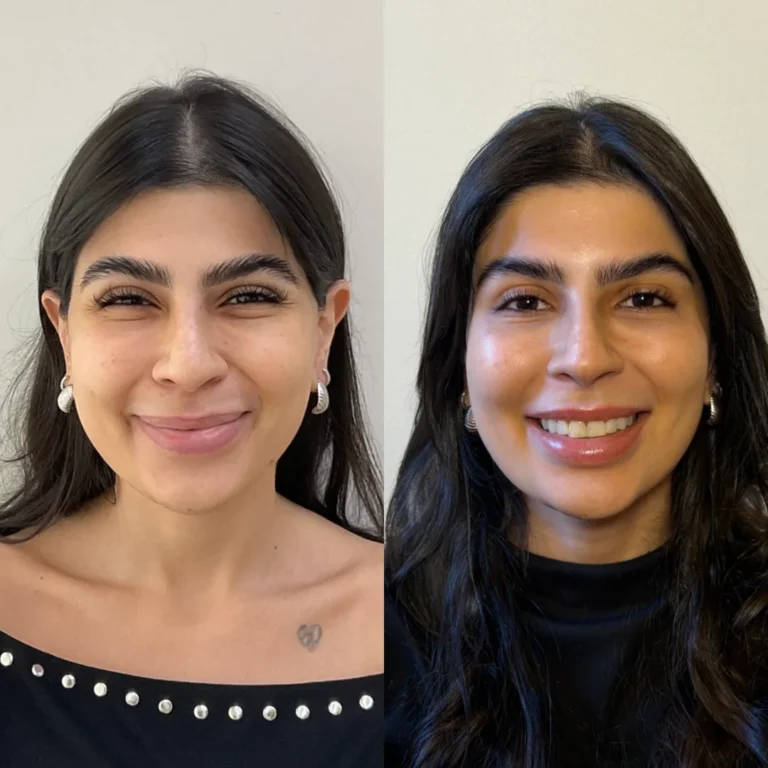 Antes e depois de toxina botulínica e preenchimento labial