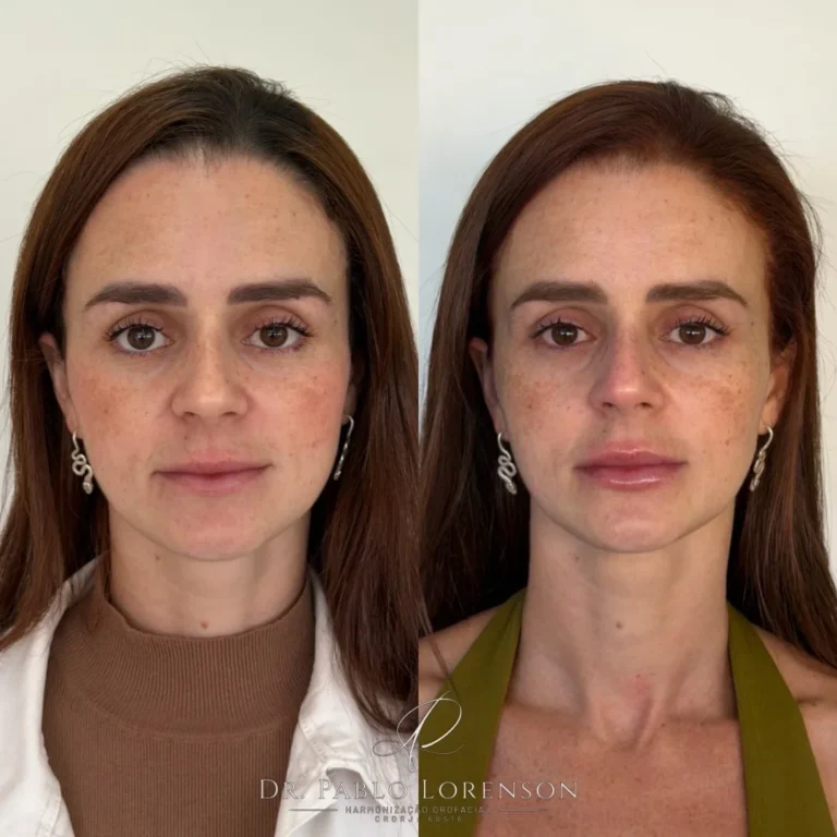 Antes e depois de harmonização facial