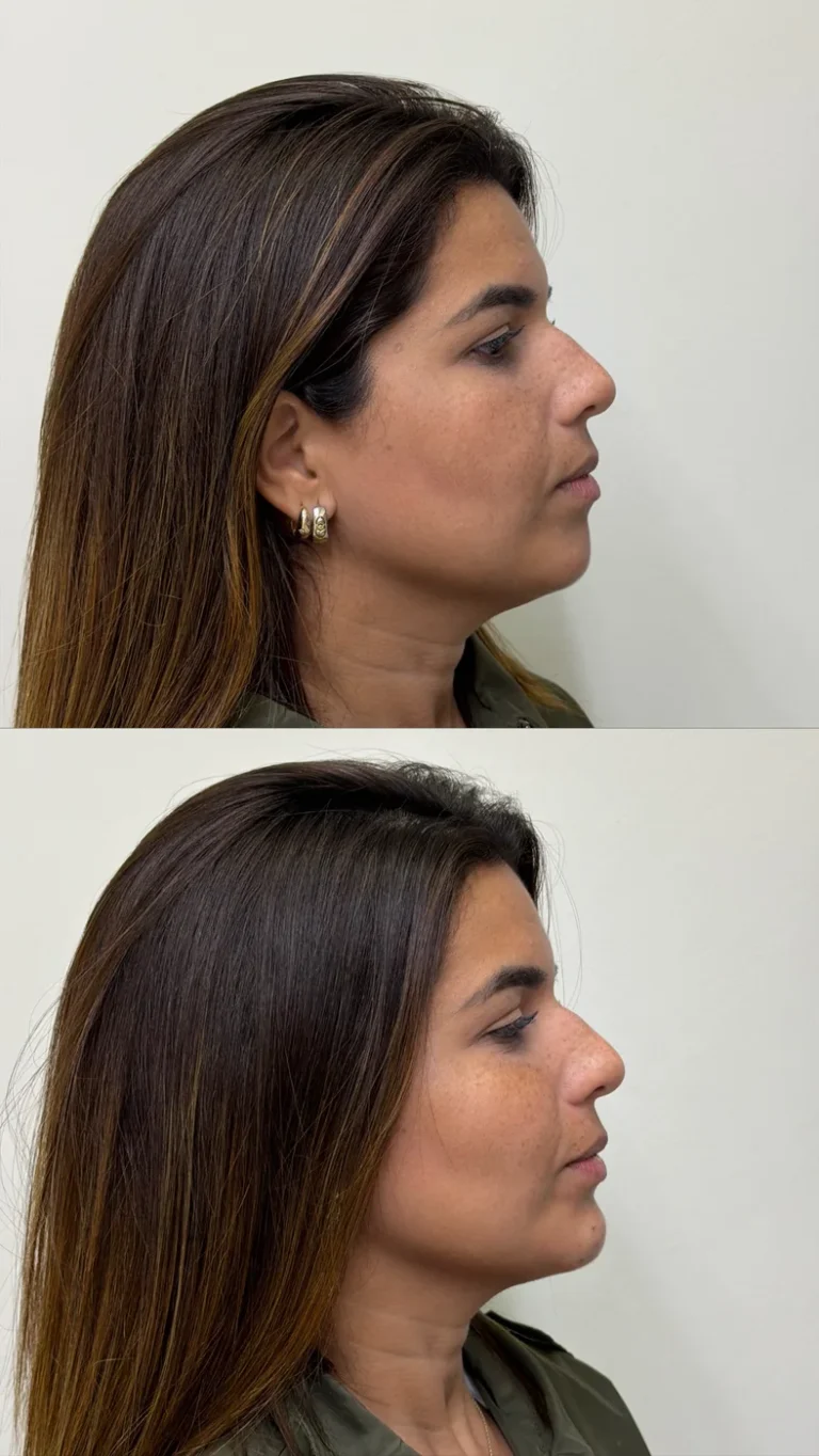 Antes e depois de contorno de mandíbula e mento